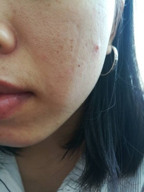 痘痘如何去除效果好(痘痘咋去除) 痘痘如何去除效果好(痘痘咋去除)