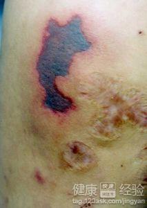 血小板减少性紫癜能根治吗(血小板减少性紫癜严重会怎样) 血小板减少性紫癜能根治吗(血小板减少性紫癜严重会怎样)